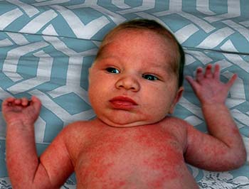 measles introduction