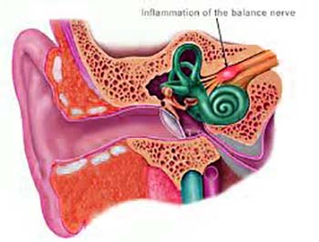 Vestibular Neuronitis Meniere's Disease Related Conditions