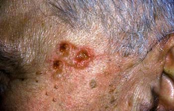 Similar Conditions of Molluscum Contagiosum