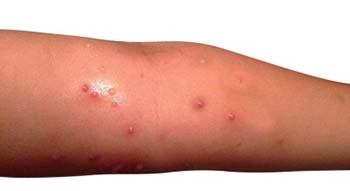 Definition of Molluscum Contagiosum