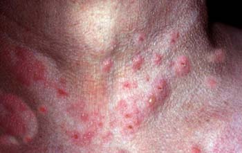 Similar Conditions of Molluscum Contagiosum