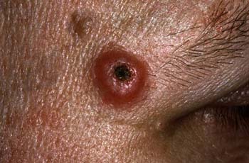 Similar Conditions of Molluscum Contagiosum