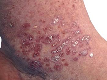 Similar Conditions of Molluscum Contagiosum