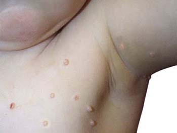 Symptoms of Molluscum Contagiosum