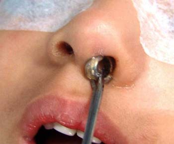 Similar Conditions of Nasal Polyps