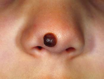 Similar Conditions of Nasal Polyps