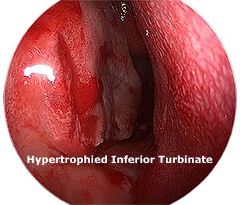 Similar Conditions of Nasal Polyps