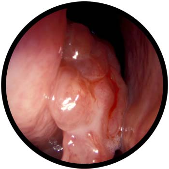 Similar Conditions of Nasal Polyps