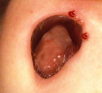 Similar Conditions of Nasal Polyps