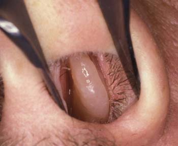 Nasal Polyps