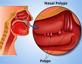 What is Nasal Polyps?