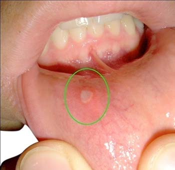 Similar condition of Oral Herpes