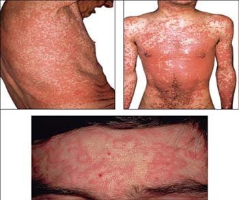 Stevens-Johnson Syndrome