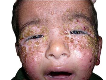 Impetigo