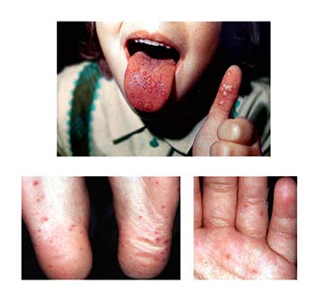 Hand, Foot and Mouth Disease (HFMD)