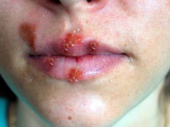 Oral Herpes