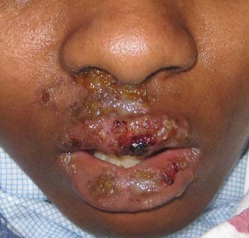 Oral Herpes Symptoms
