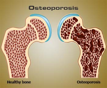 Osteoporosis Definition