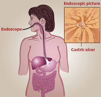 diagnosis and tests of peptic ulcer