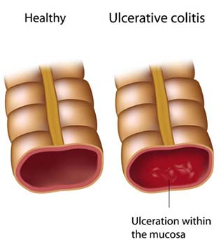 Similar conditions of Piles