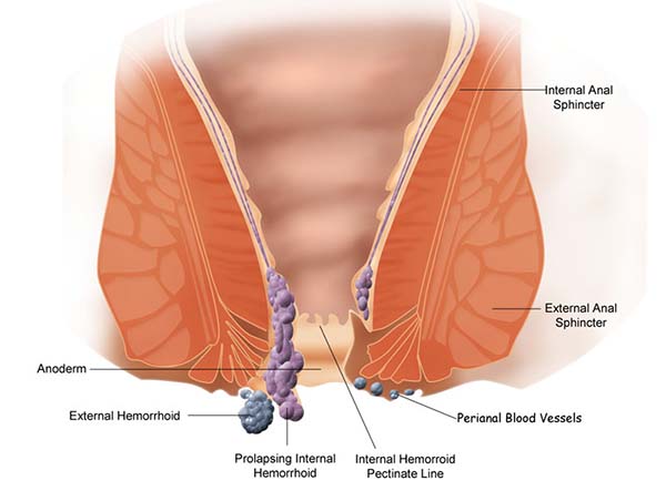 Piles Hemorrhoids Defination