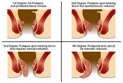 Definition of Piles Hemorrhoids