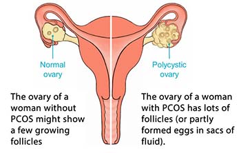 Polycystic Ovary Syndrome (PCOS)