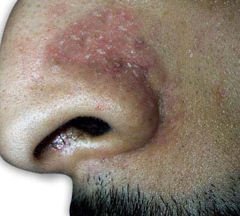 Seborrheic Dermatitis