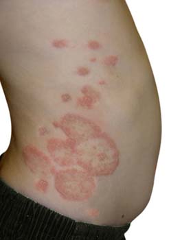 Ringworm (tinea corporis)