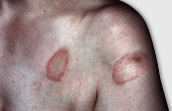 Pityriasis Rosea