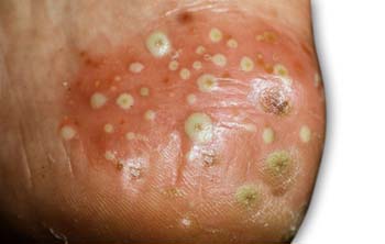 Symptoms of Psoriasis