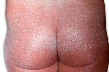 Symptoms of Psoriasis