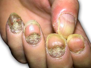 Symptoms of Psoriasis