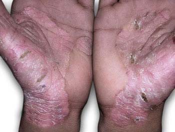 Symptoms of Psoriasis