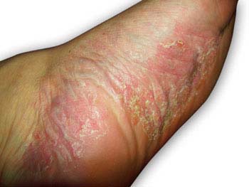 Symptoms of Psoriasis