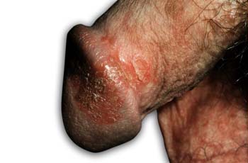 Symptoms of Psoriasis