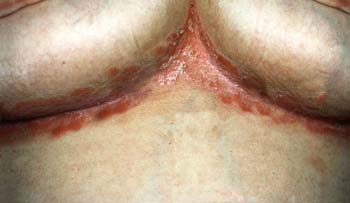 Symptoms of Psoriasis