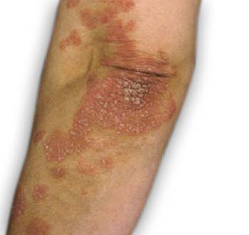 Symptoms of Psoriasis