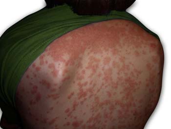 Symptoms of Psoriasis