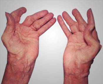 Summary of Rheumatoid Arthritis