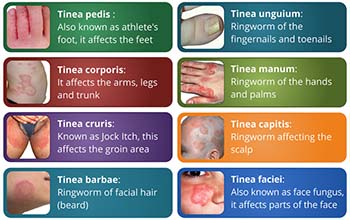 Symptoms of Ringworm