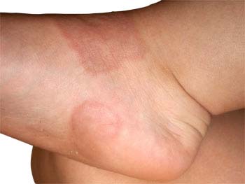 Similar Conditions of Ringworm