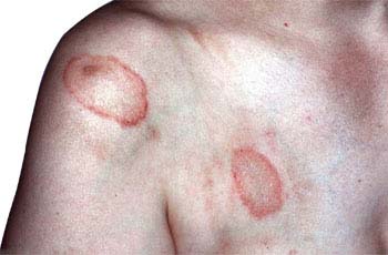 Similar Conditions of Ringworm