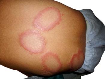 Similar Conditions of Ringworm