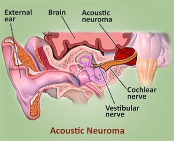 Tinnitus Similar Condition