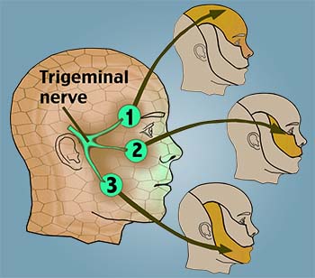 trigeminal neuralgia definition