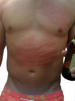 Summary of Hives (Urticaria)