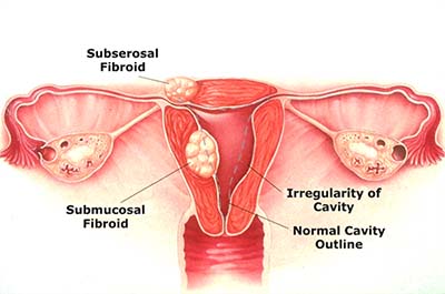 Introduction of Uterine Fibroids
