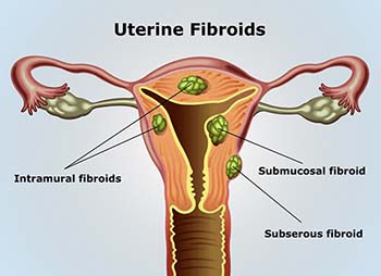 Definition of Uterine Fibroids