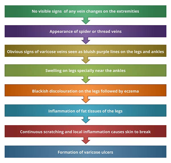 Symptoms of Varicose Veins